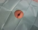 Břišní jizvy a hojení rány po abdominoplastice