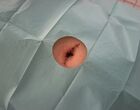 Břišní jizvy a hojení rány po abdominoplastice