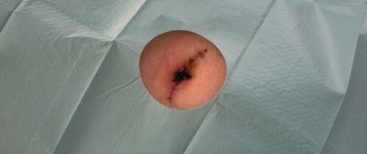 Břišní jizvy a hojení rány po abdominoplastice