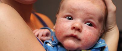Atopická dermatitida: víme, co skutečně pomáhá