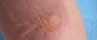 Kožní štěp – křehká pomoc poraněné kůži 